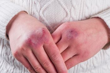 Als Erstes anfällig bei einer Unterkühlung sind die Extremitäten wie Hände und Füße.